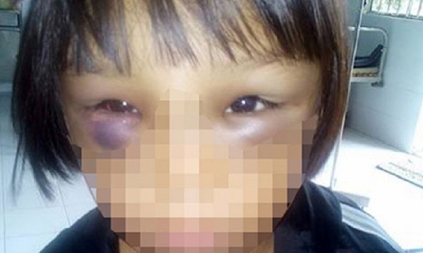 Tây Ninh: Phát hiện bé gái 7 tuổi có dấu hiệu bị bạo hành